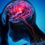 İnme Nöroloğundan Uyarı: 'Erken Müdahale İnmeyi Önler'